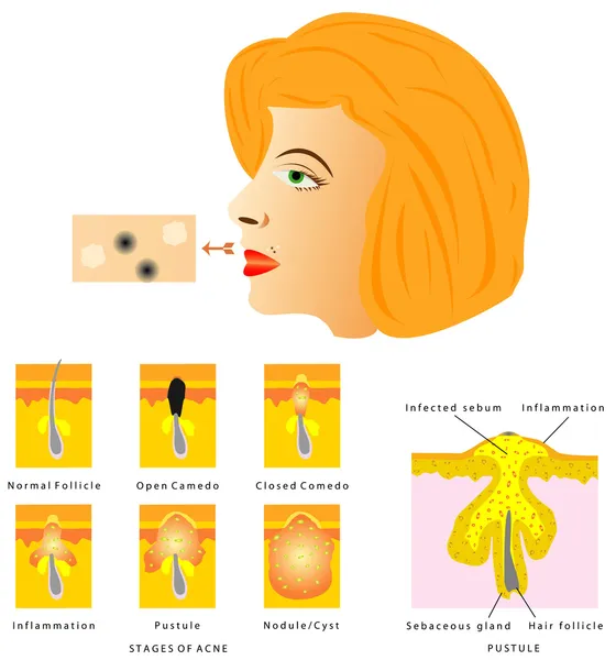 Formação de acne na pele — Vetor de Stock