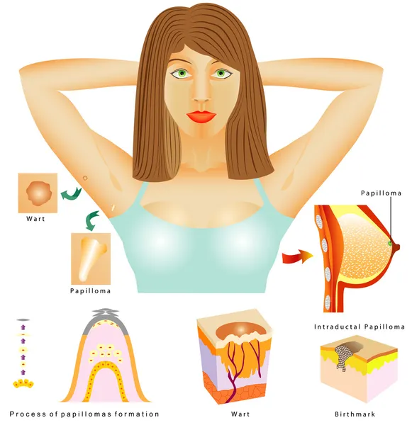 Papilloma — Vettoriale Stock