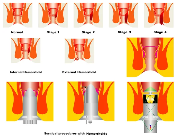 Hemorrhoid — Stockový vektor