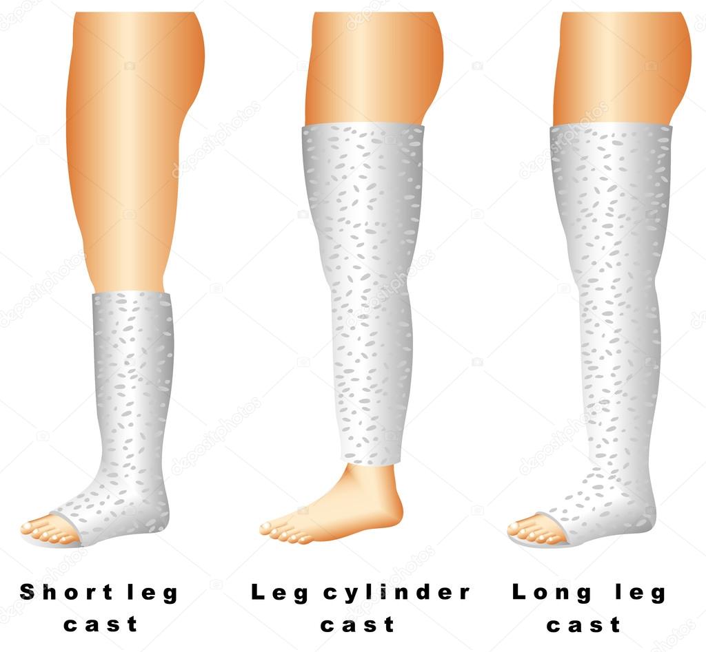 Leg casts