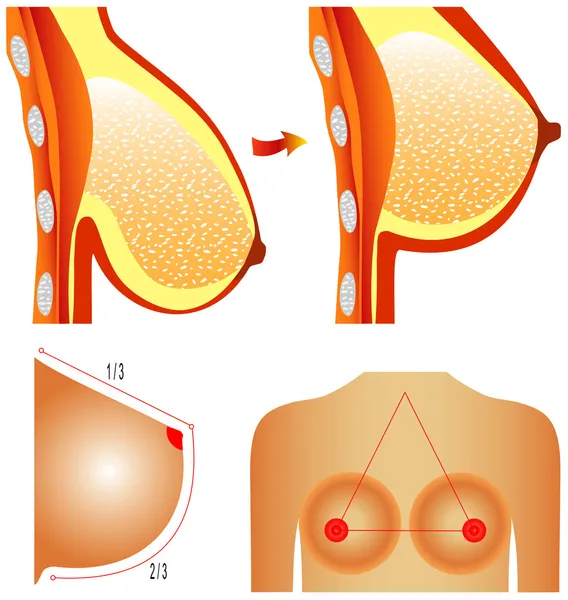 乳房整形手术 — 图库矢量图片