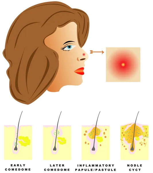 痤疮 — 图库矢量图片