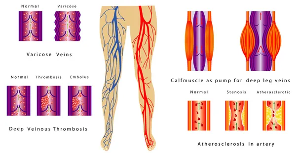 Piernas del sistema vascular — Vector de stock