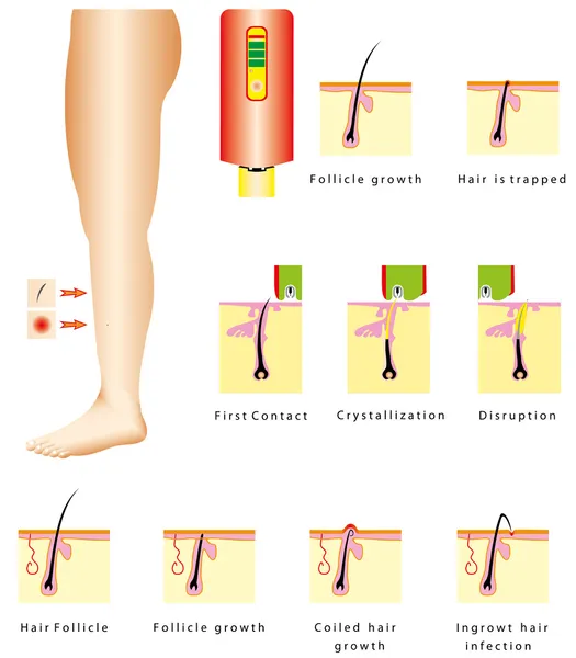 Epilation — Stock Vector