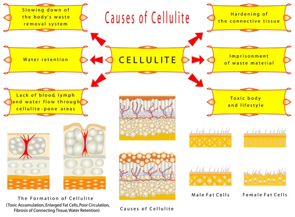 Bildung von Cellulite — Stockvektor