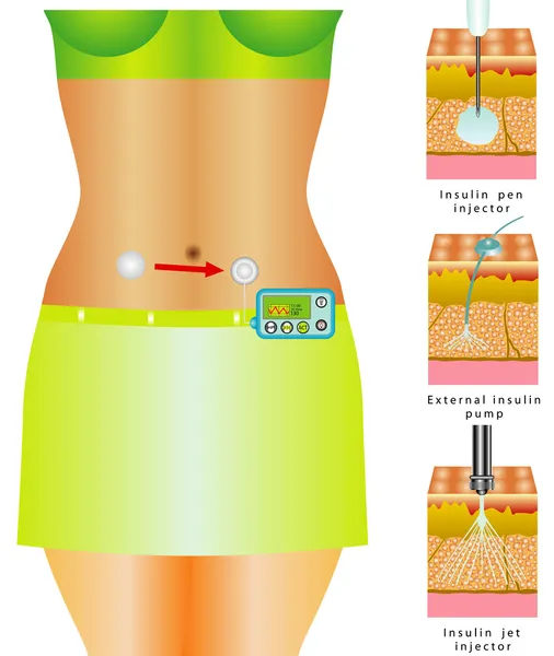 Monitoreo de glucosa — Vector de stock