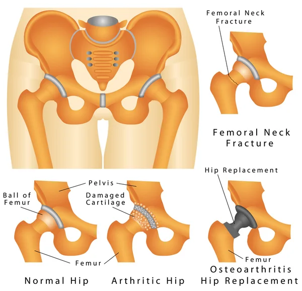 髋关节 — 图库矢量图片
