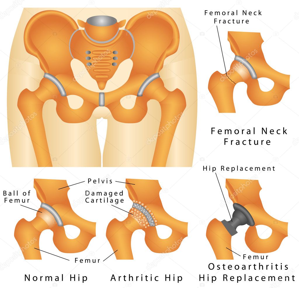 midocal a csípőízület artrózisában