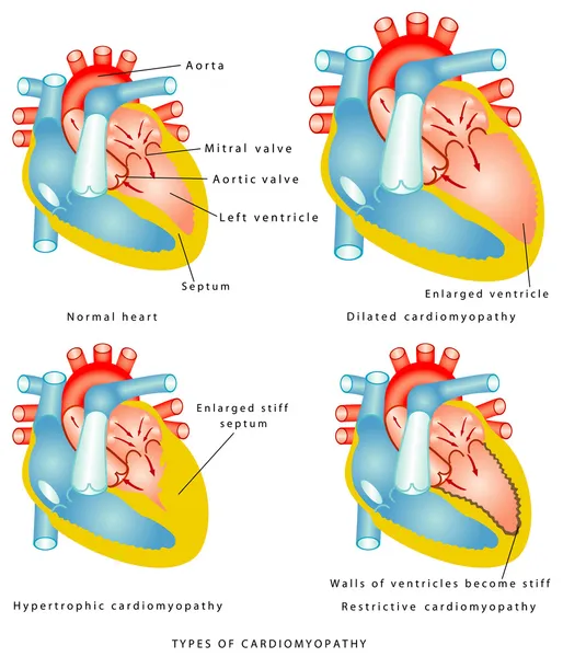 Malattie del muscolo cardiaco — Vettoriale Stock