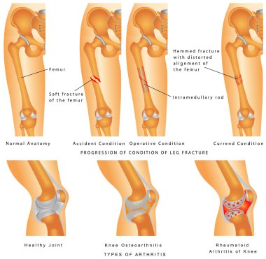 kırıklar femur