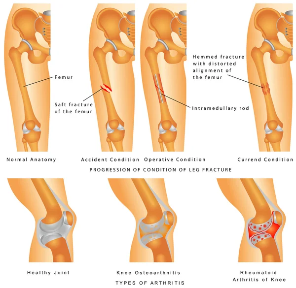 Fracturas de fémur — Archivo Imágenes Vectoriales