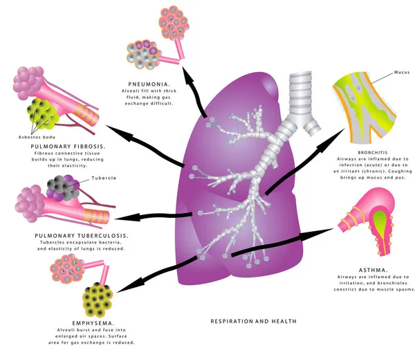 Respiration Santé Infections Des Voies Respiratoires Supérieures Inférieures Sinusite Otite Graphismes Vectoriels