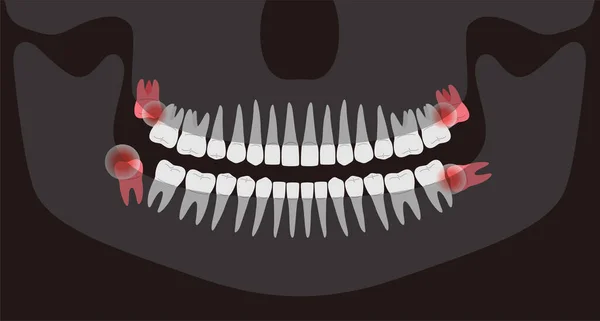 Human Ray Picture Teeth Vector Illustration Inflamed Teeth Human Hurts — ストックベクタ