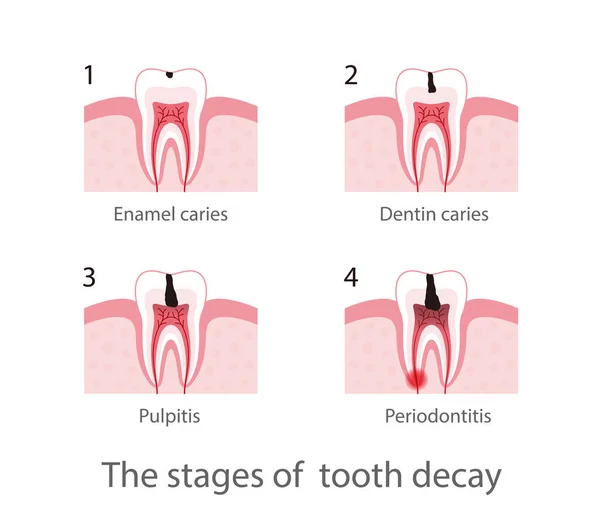 Етапи Розпаду Зуба Векторні Ілюстрації — стоковий вектор