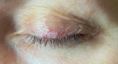 Yakın çekim fotoğraf, seçici odaklanma, ciltte dermatolojik enfeksiyon, göz kapağında demokrat.