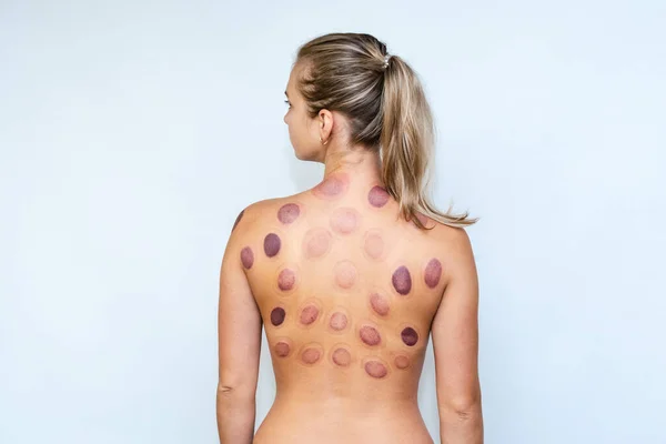 Woman after a vacuum massage with cans. Acupressure of the back. Hematomas after vacuum treatment of the back