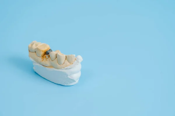Study model of teeth and gums. On blue background. Dental concept