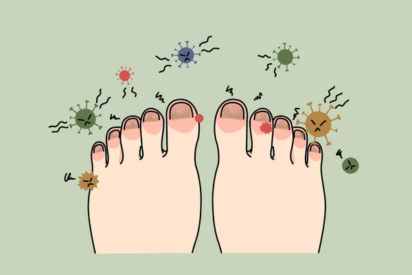 Tırnak enfeksiyonu ya da virüsü olan sağlıksız ayak — Stok Vektör