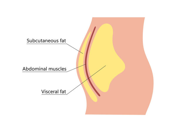 Внутренний и подкожный жир вокруг талии. Расположение висцерального жира в брюшной полости. Виды ожирения человека. Медицинская схема. Векторная иллюстрация на белом фоне.
