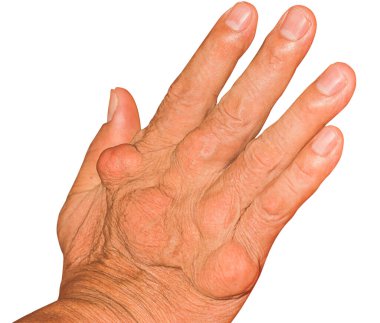 Eklem ağrısı, kemik ağrısı, gut, romatizma semptomları, radyoaktif hastalık, erkek osteoporozu, yaralı kemik, yaralanma, ağrı, eklem iltihabı, kol, diz, diz