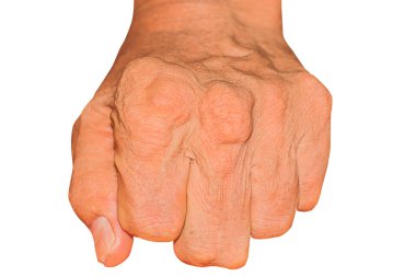 Eklem ağrısı, kemik ağrısı, gut, romatizma semptomları, radyoaktif hastalık, erkek osteoporozu, yaralı kemik, yaralanma, ağrı, eklem iltihabı, kol, diz, diz