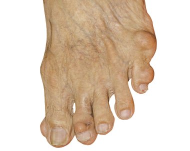 Eklem ağrısı, kemik ağrısı, gut, romatizma semptomları, radyoaktif hastalık, erkek osteoporozu, yaralı kemik, yaralanma, ağrı, eklem iltihabı, kol, diz, diz