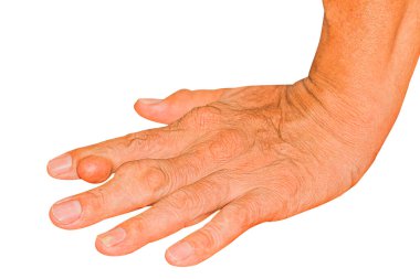 Eklem ağrısı, kemik ağrısı, gut, romatizma semptomları, radyoaktif hastalık, erkek osteoporozu, yaralı kemik, yaralanma, ağrı, eklem iltihabı, kol, diz, diz