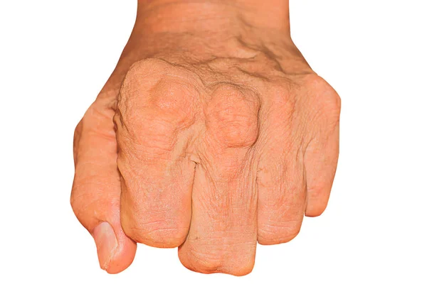 Súlyos Köszvény Ízületi Fájdalomtól Csontfájdalomtól Köszvénytől Reumás Tünetektől Radioaktív Betegségtől — Stock Fotó