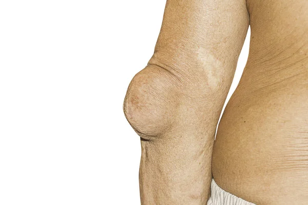 患有关节疼痛 类风湿症状 放射性疾病 男性骨质疏松症 受伤骨 关节炎 膝盖的男性严重痛风 — 图库照片