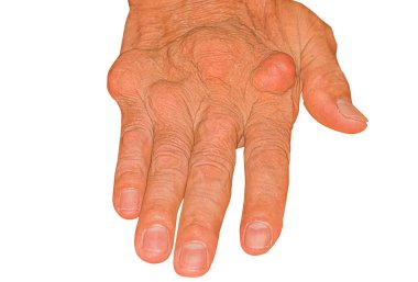 Eklem ağrısı, kemik ağrısı, gut, romatizma semptomları, radyoaktif hastalık, erkek osteoporozu, yaralı kemik, yaralanma, ağrı, eklem iltihabı, kol, diz, diz