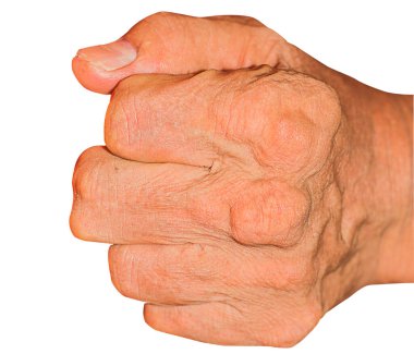 Eklem ağrısı, kemik ağrısı, gut, romatizma semptomları, radyoaktif hastalık, erkek osteoporozu, yaralı kemik, yaralanma, ağrı, eklem iltihabı, kol, diz, diz