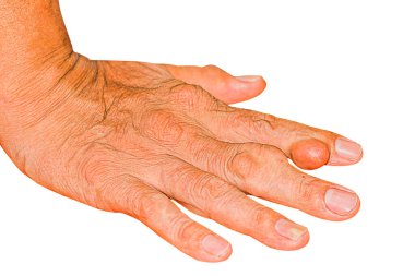 Eklem ağrısı, kemik ağrısı, gut, romatizma semptomları, radyoaktif hastalık, erkek osteoporozu, yaralı kemik, yaralanma, ağrı, eklem iltihabı, kol, diz, diz