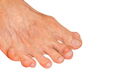 Eklem ağrısı, kemik ağrısı, gut, romatizma semptomları, radyoaktif hastalık, erkek osteoporozu, yaralı kemik, yaralanma, ağrı, eklem iltihabı, kol, diz, diz