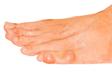 Eklem ağrısı, kemik ağrısı, gut, romatizma semptomları, radyoaktif hastalık, erkek osteoporozu, yaralı kemik, yaralanma, ağrı, eklem iltihabı, kol, diz, diz