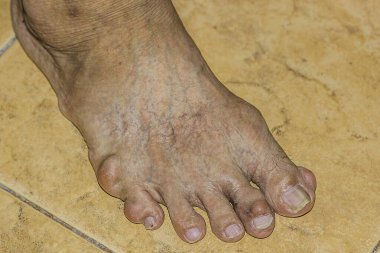 Eklem ağrısı, kemik ağrısı, gut, romatizma semptomları, radyoaktif hastalık, erkek osteoporozu, yaralı kemik, yaralanma, ağrı, eklem iltihabı, kol, diz, diz