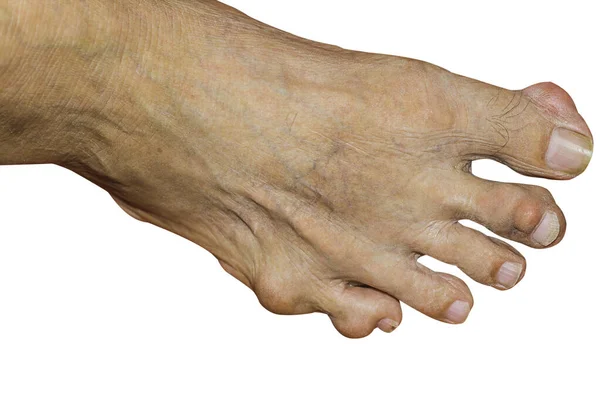 Eklem ağrısı, kemik ağrısı, gut, romatizma semptomları, radyoaktif hastalık, erkek osteoporozu, yaralı kemik, yaralanma, ağrı, eklem iltihabı, kol, diz, diz