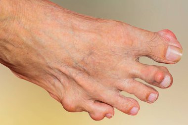 Eklem ağrısı, kemik ağrısı, gut, romatizma semptomları, radyoaktif hastalık, erkek osteoporozu, yaralı kemik, yaralanma, ağrı, eklem iltihabı, kol, diz, diz