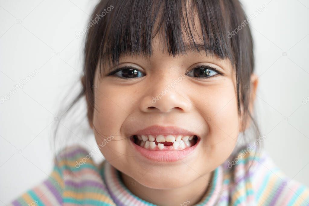 little Asian girl showing her broken milk teeth.