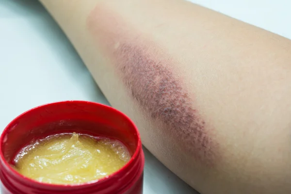 Braço com cicatriz e pomada médica — Fotografia de Stock
