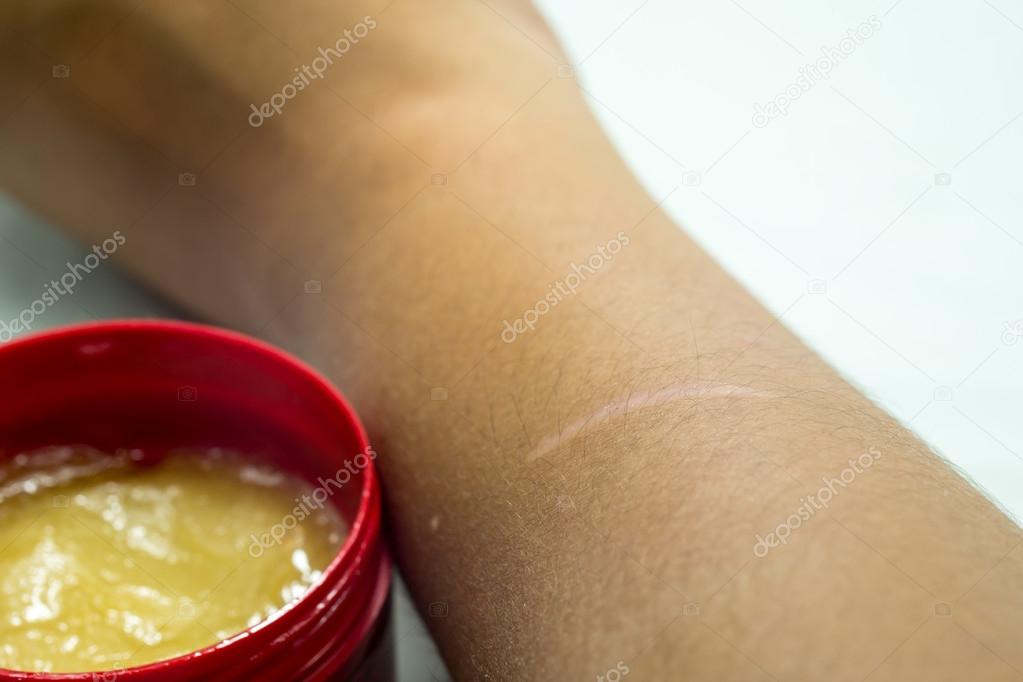 Arm with Scar and medical ointment