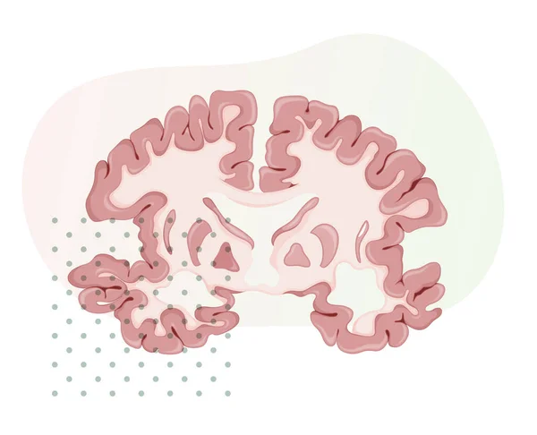 Morbo Alzheimer Sezione Trasversale Del Cervello Illustrazione Come File Eps — Vettoriale Stock