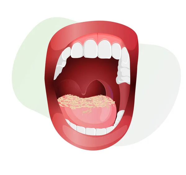 Open Mouth Fungal Infection Tongue Stock Illustration Eps File — Vetor de Stock
