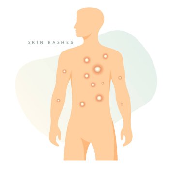 Monkeypox - Skin Rashes and Spots as Symptoms - Icon as EPS 10 File