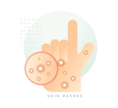 Monkeypox - Skin Rashes and Spots as Symptoms - Icon as EPS 10 File