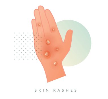 Monkeypox - Skin Rashes and Spots as Symptoms - Icon as EPS 10 File
