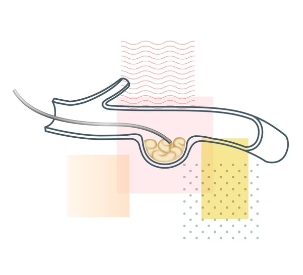 Aneurysm Vascular Stent Procedure Stock Illustration Eps File — Stockvektor