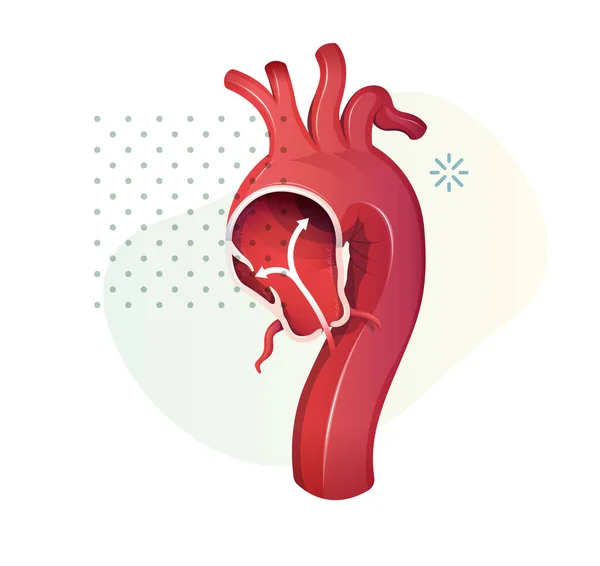 Aortic Aneurysm Stock Illustration Eps File — Wektor stockowy