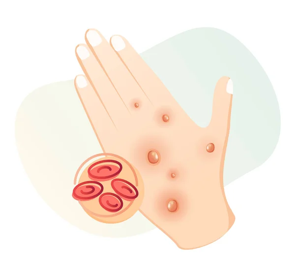Monkeypox Skin Rashes Spots Symptoms Icon Eps File — Vector de stock