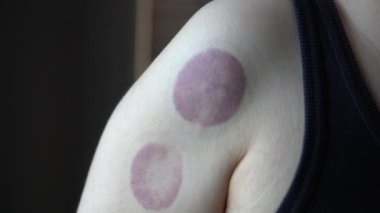 Emici fincanlarda çürük izleri var. Kan dolaşımı için alternatif terapi ağrı kesici.