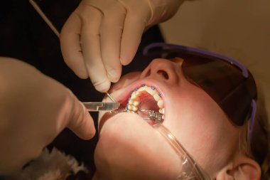 Diş tellerinin bağlanması. Ortodontik tedavi. Ortodontist metal parantez ve diş büyüteç taktı. Dişçi koltuğunda ağzı açık bir kız..